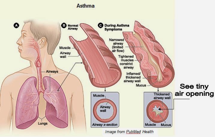 ब र ब र क इट स Bronchitis क लक षण एव उपच र Bronchitis Disease In Hindi